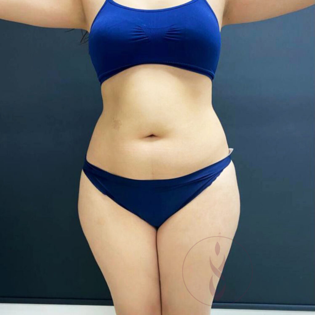 CasoLipoescultura_Antes_DrVictorMoscoso