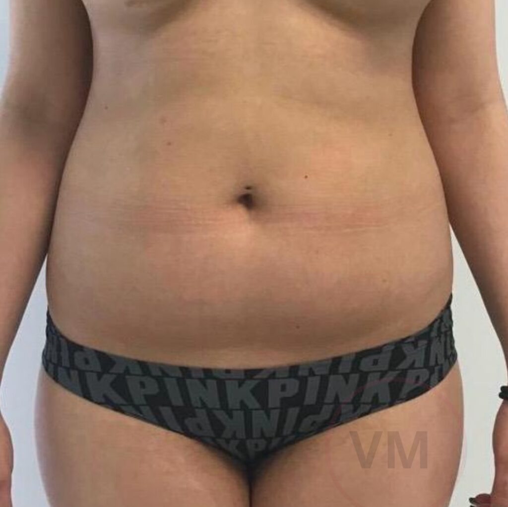 Lipo HD Victor Moscoso