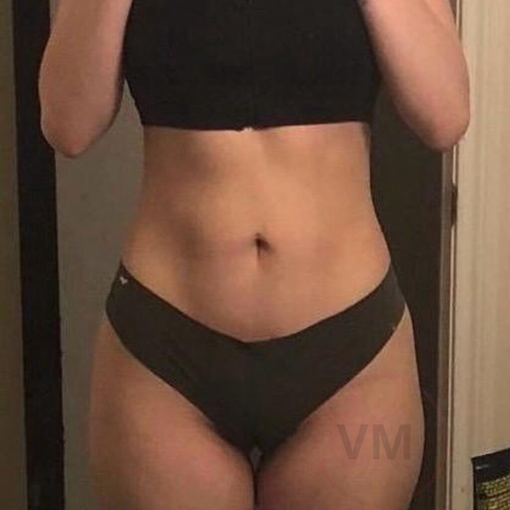 Lipo HD Victor Moscoso